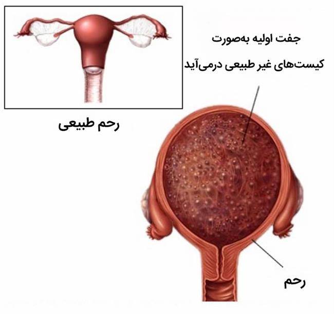 علائم و نشانه های حاملگی مولار