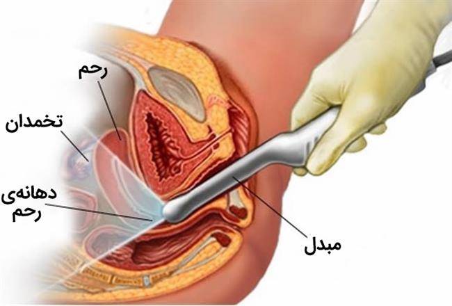 علائم و نشانه های حاملگی مولار