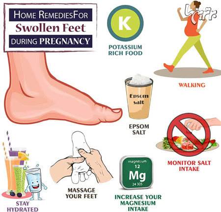 درمان خانگی تورم پاها در دوران بارداری