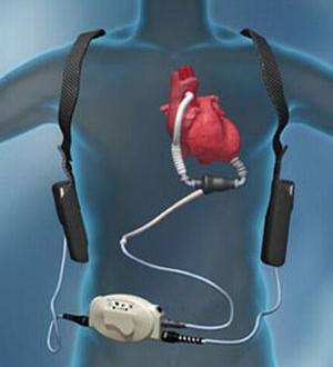 تایید اولین وسیله کمک قلبی کم حجم