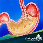 آسم و ریفلاکس اسید معده