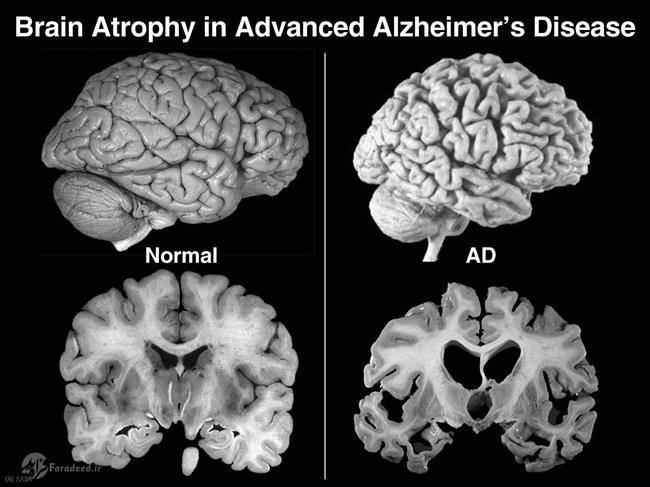 چرا گاهی اوقات به آلزایمر دچار می‌شویم؟ / گزارش