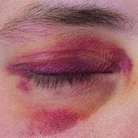 رنگهای کبودی به چه معنا هستند؟