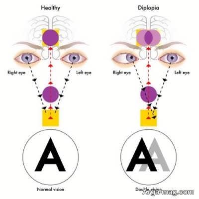 علل، علائم و روش های درمان دوبینی چشم را بهتر بشناسید