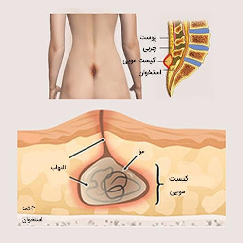 جراحی بیماری های نشیمنگاهی را فراموش کنید! لیزر بهترین جایگزین برای جراحی