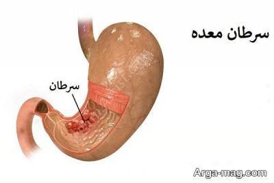 علائم سرطان معده و آشنایی با روش های درمان و مبارزه با این بیماری