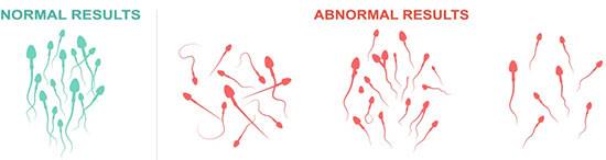 16 مورد در آزمایش اسپرم و تفسیر آنلاین آن