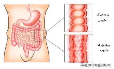 علایم کولیت زخمی