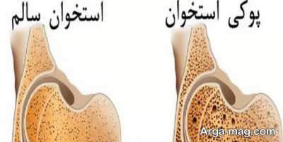 درمان پوکی استخوان با راهکارهای متفاوت و شناخت عوامل بروز این بیماری