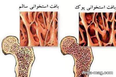 درمان بیماری پوکی استخوان