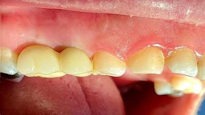 مزیت‌های ایمپلنت دندان