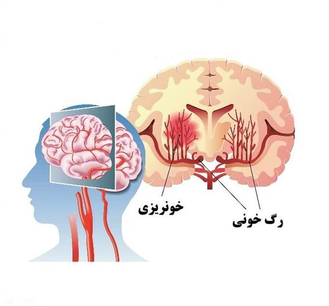 خونریزی مغزی؛ علائم و درمان