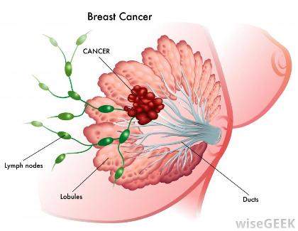 سرطان سینه