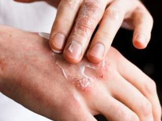 10 نکته مهم برای پیشگیری از خشکی پوست در فصل سرما