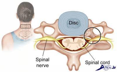 دیسک گردن