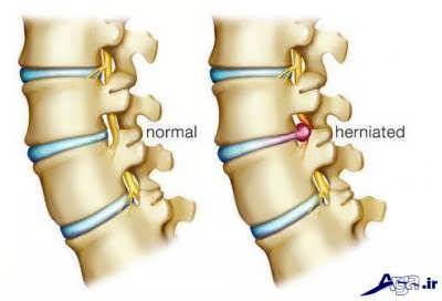 بررسی علائم دیسک گردن