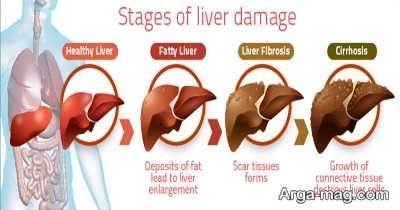 علایم نارسایی مزمن و حاد کبد