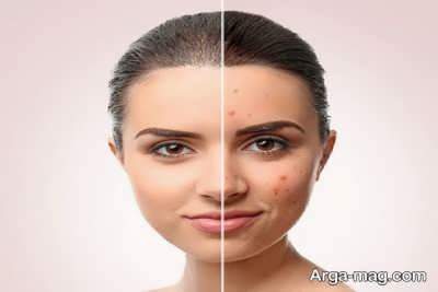 فواید زنیان بر سلامت پوست
