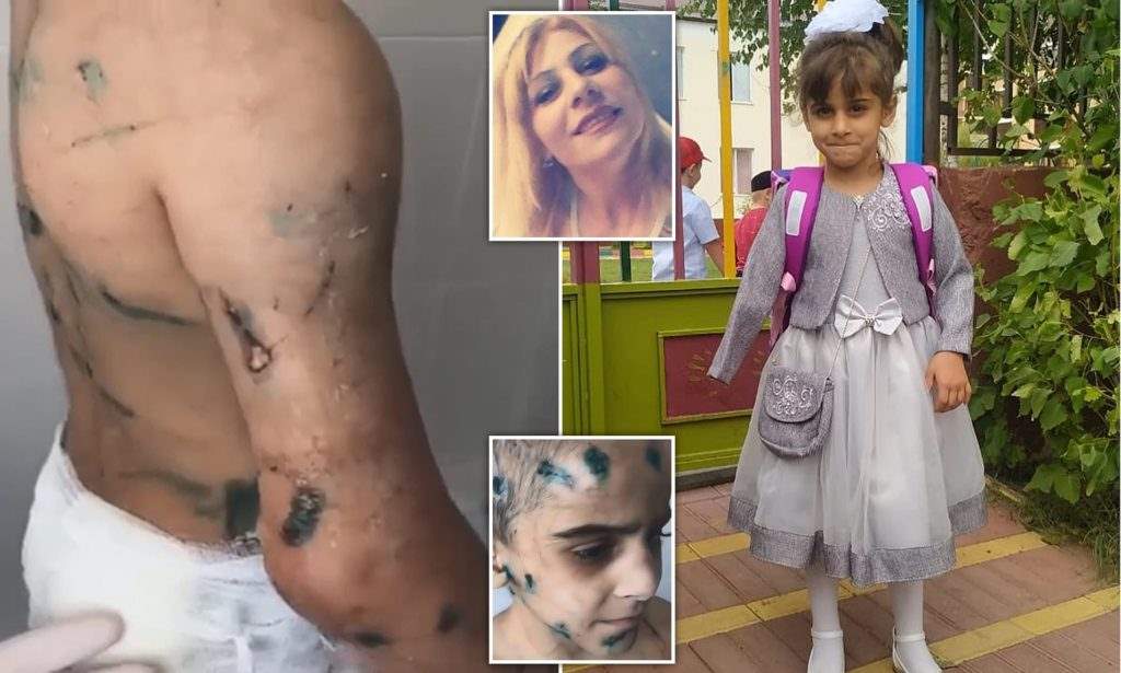 شکنجه‌های هولناک عمه شیطان‌صفت باعث قطع شدن دست دختر 7 ساله شد + ویدیو