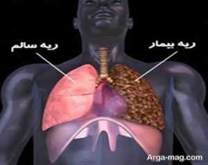 روش های پیشگیری از سرطان ریوی