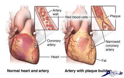 چرا دچار گرفتگی رگ قلب می شویم؟