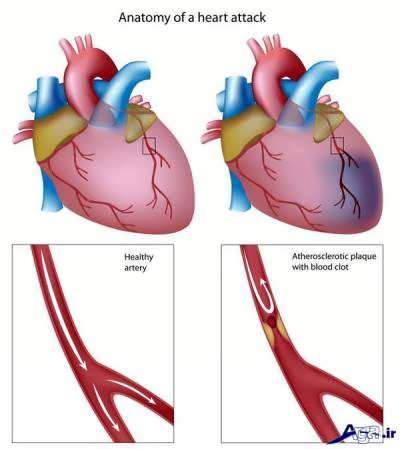 درمان گرفتگی رگ قلب