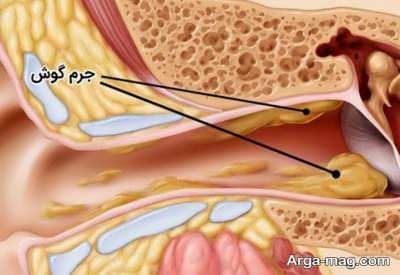 رفع جرم گوش و تمیز کردن اصولی گوش در خانه