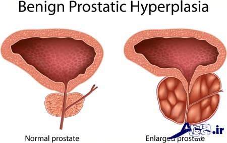 درمان بیماری پروستات