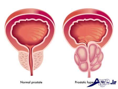 درمان بزرگی پروستات در مردان