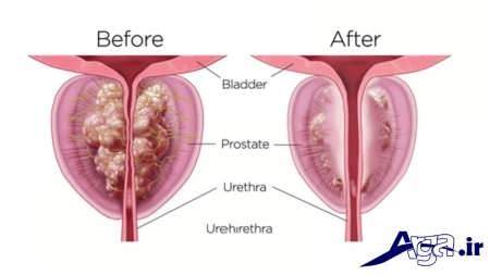 درمان بزرگی پروستات