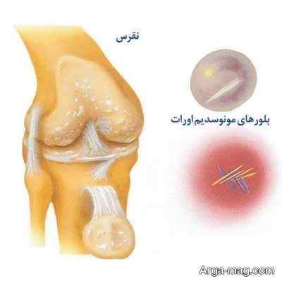 نشانه ها و علایم بیماری نقرس چیست؟ 