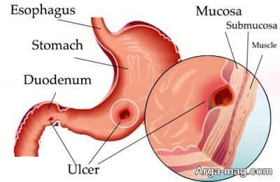 درمان طبیعی زخم معده با راهکارهای عالی و اثر بخش