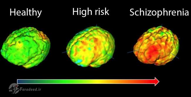 از کجا بدانیم که داریم به اسکیزوفرنی مبتلا می‌شویم؟