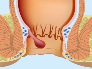 هموروئید در زنان از علت تا درمان