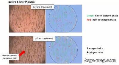 وضعیت رشد موها پس از مصرف ماینوکسیدیل