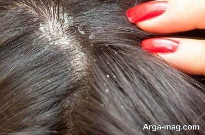 تقویت رشد مو با روغن سیر