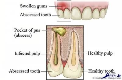 آبسه دندان و لثه چیست
