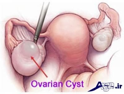 درمان کیست تخمدان