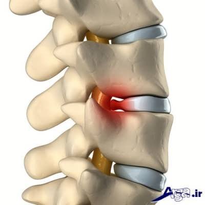 روش های درمانی دیسک کمر