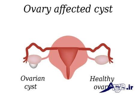 علایم قابل توجه کیست تخمدان
