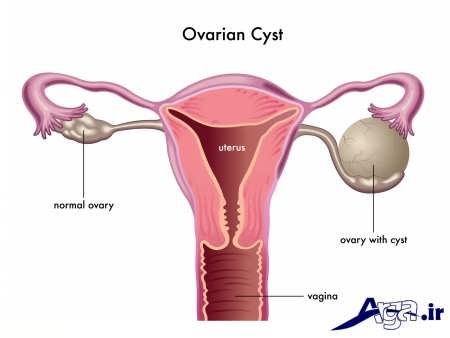 علایم و تشخیص کیست تخمدان
