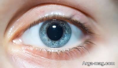 گشادی مردمک چشم چه دلیلی دارد؟