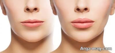 از بین بردن فاصله زیاد بین لب و بینی