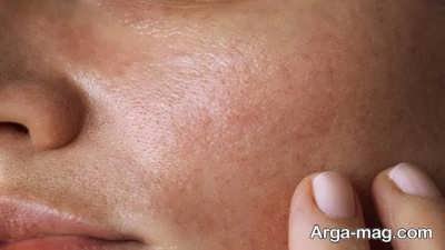 عادت های مضر برای پوست