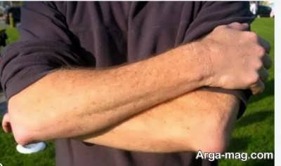 معالجه بورسیت آرنج