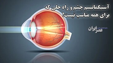 آستیگماتیسم چشم؛ بیماری شایع با درمانی که برای همه مناسب نیست (فیلم)