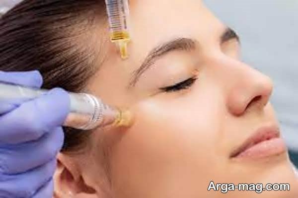  کاربرد دستگاه مزونیدلینگ