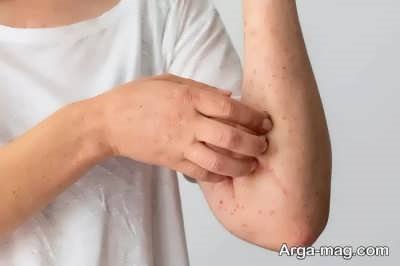 نشانه های آلرژی به لاتکس