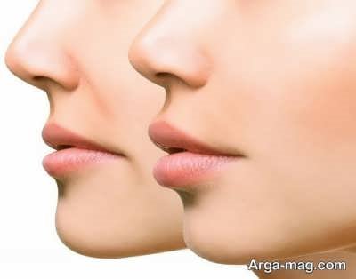 افراد مستعد برای این جراحی
