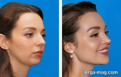 نحوه انجام این جراحی